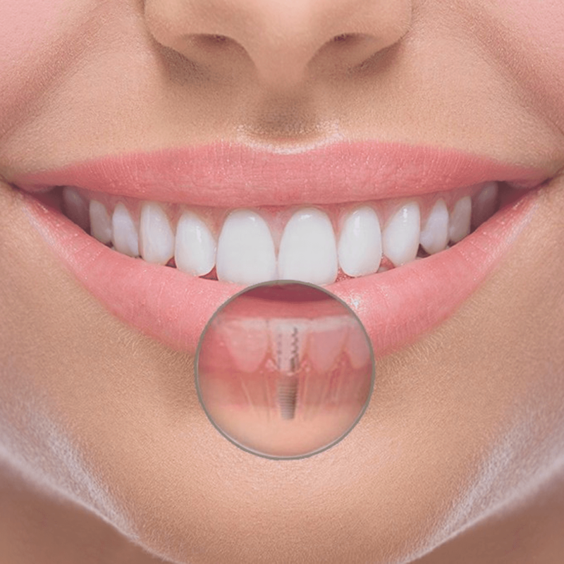 Cirugía Apical por la Odontóloga Marcela Figueroa en Bogotá, especialista en eliminar infecciones persistentes en la raíz del diente. Apical Surgery by Dentist Marcela Figueroa in Bogotá, specialist in removing persistent root infections.