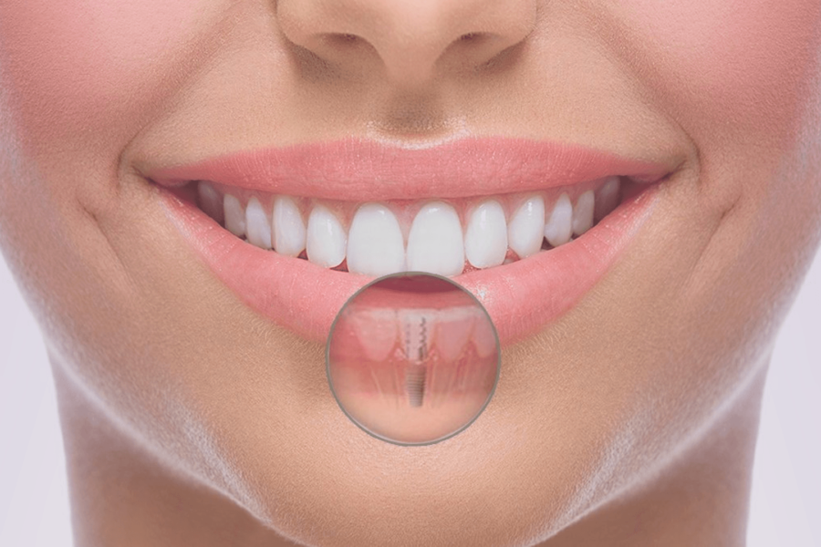 Cirugía Apical por la Odontóloga Marcela Figueroa en Bogotá, especialista en eliminar infecciones persistentes en la raíz del diente. Apical Surgery by Dentist Marcela Figueroa in Bogotá, specialist in removing persistent root infections.